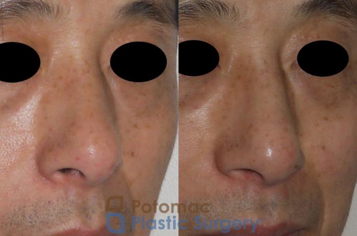 Before & After Rhinoplasty - Medical Case 115 Right Oblique View in Washington DC & Arlington , DC