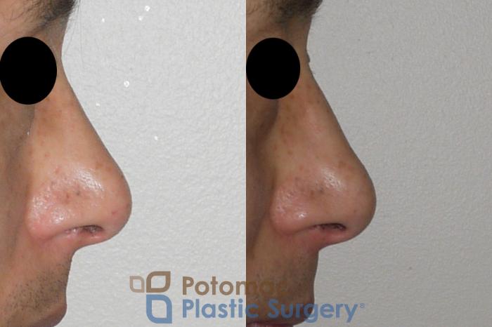 Before & After Rhinoplasty - Cosmetic Case 115 Right Side View in Washington DC & Arlington , DC