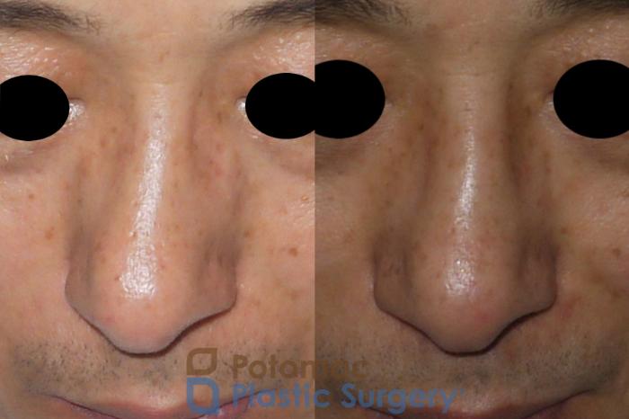 Before & After Rhinoplasty - Cosmetic Case 115 Top View in Washington DC & Arlington , DC