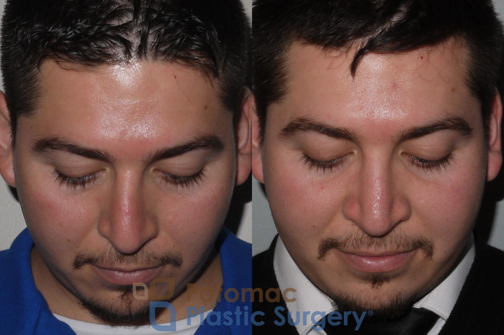 Before & After Rhinoplasty - Medical Case 116 Above View in Washington, DC