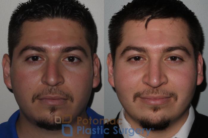 Before & After Rhinoplasty - Medical Case 116 Front View in Washington DC & Arlington , DC