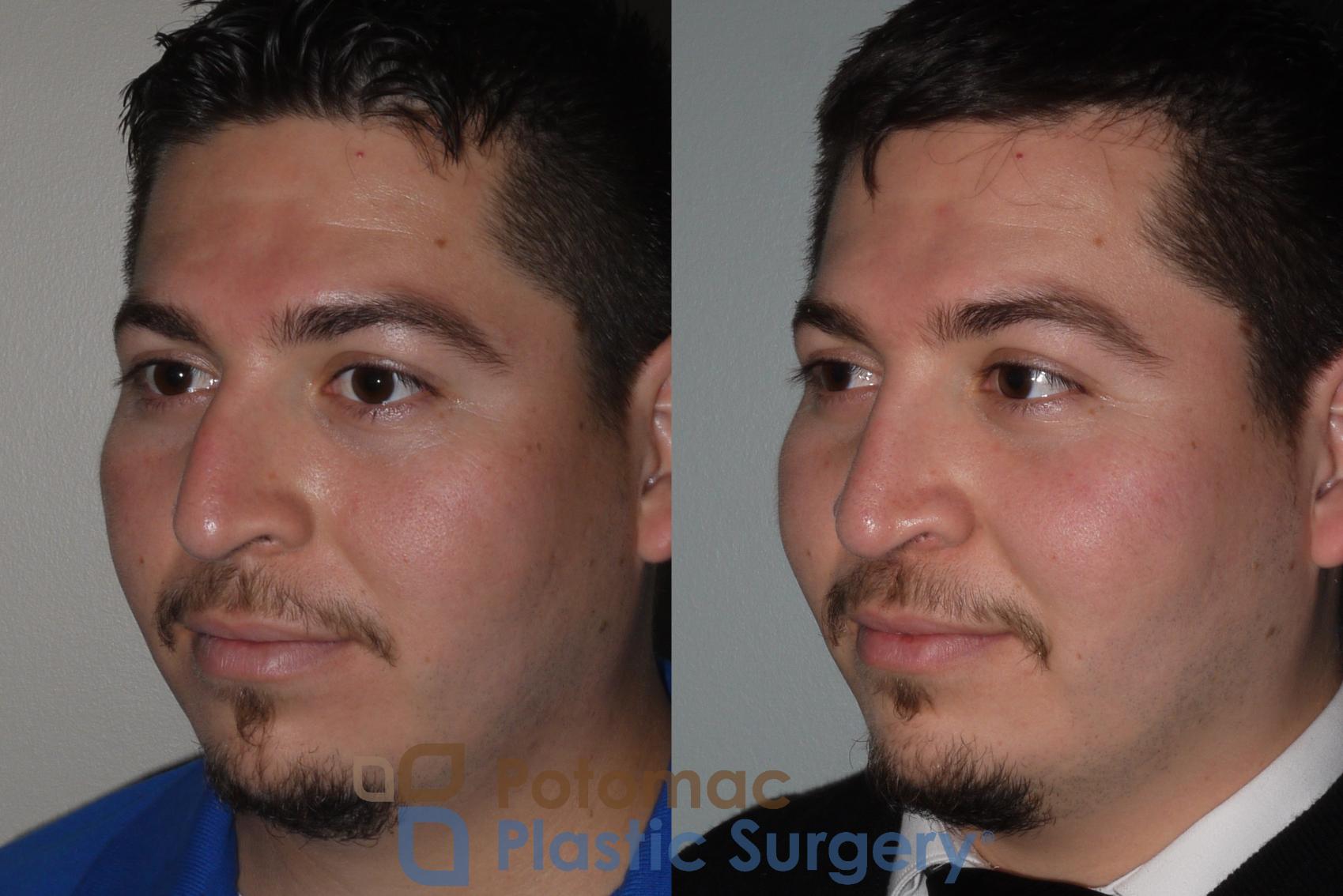 Before & After Rhinoplasty - Medical Case 116 Left Oblique View in Washington, DC