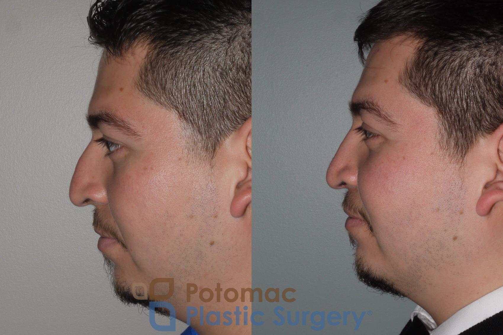 Before & After Rhinoplasty - Medical Case 116 Left Side View in Washington, DC