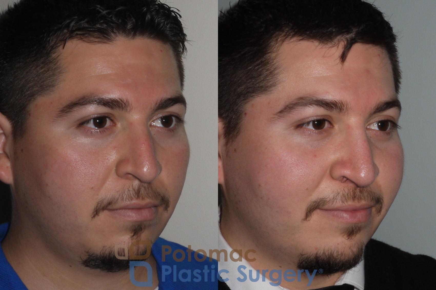 Before & After Rhinoplasty - Medical Case 116 Right Oblique View in Washington, DC