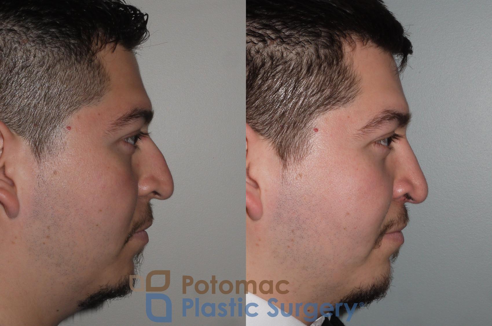 Before & After Rhinoplasty - Medical Case 116 Right Side View in Washington, DC