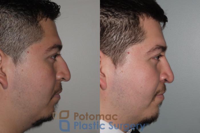 Before & After Rhinoplasty - Cosmetic Case 116 Right Side View in Washington DC & Arlington , DC