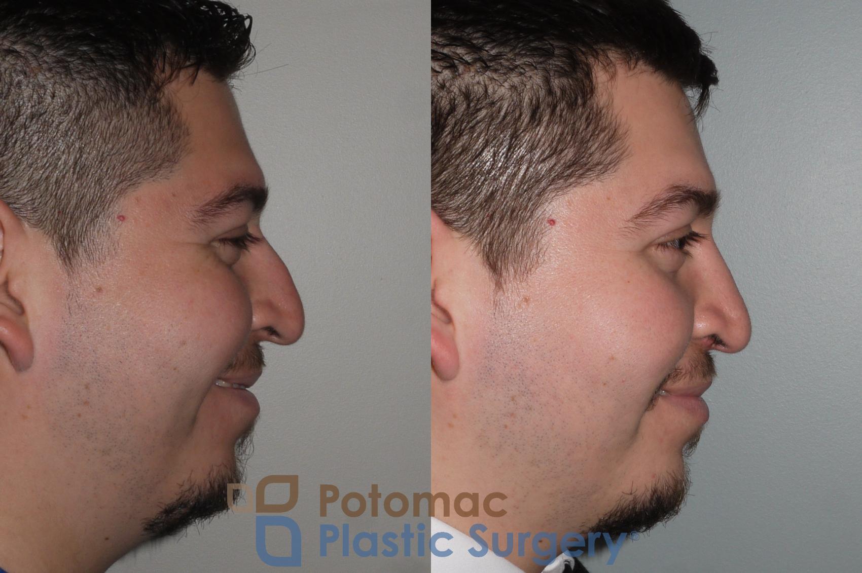 Before & After Rhinoplasty - Medical Case 116 Right Side View #2 View in Washington, DC
