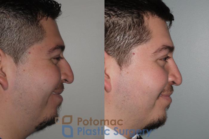 Before & After Rhinoplasty - Cosmetic Case 116 Right Side View #2 View in Washington DC & Arlington , DC