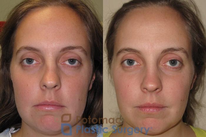 Before & After Rhinoplasty - Medical Case 13 Front View in Washington DC & Arlington , DC