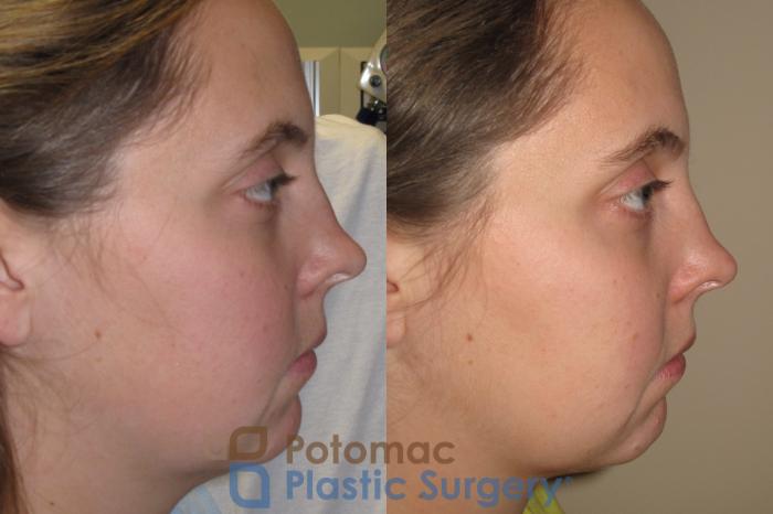 Before & After Rhinoplasty - Medical Case 13 Right Side View in Washington DC & Arlington , DC