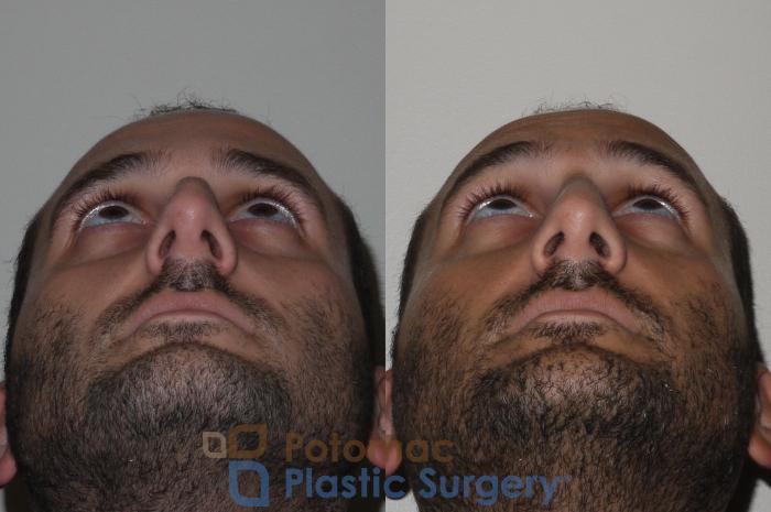 Before & After Rhinoplasty - Medical Case 132 Bottom View in Washington DC & Arlington , DC