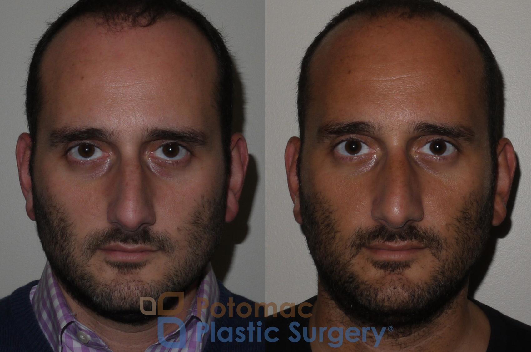 Before & After Rhinoplasty - Medical Case 132 Front View in Washington DC & Arlington , DC
