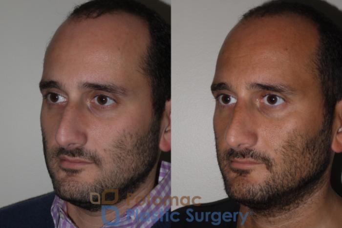 Before & After Rhinoplasty - Cosmetic Case 132 Left Oblique View in Washington DC & Arlington , DC