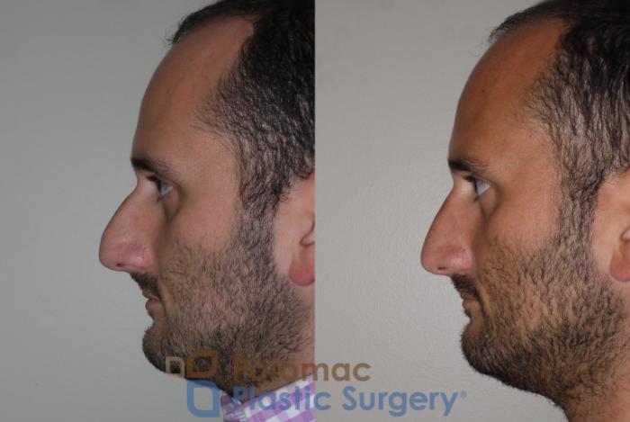 Before & After Rhinoplasty - Cosmetic Case 132 Left Side View in Washington DC & Arlington , DC