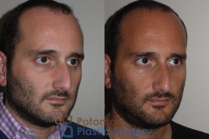 Before & After Rhinoplasty - Medical Case 132 Right Oblique View in Washington DC & Arlington , DC