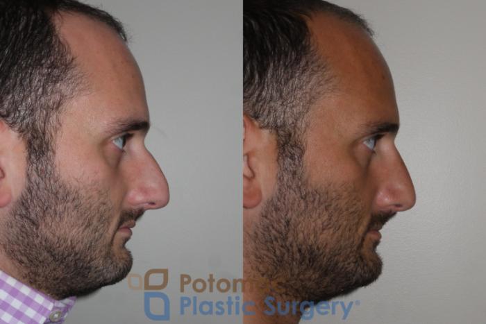 Before & After Rhinoplasty - Medical Case 132 Right Side View in Washington DC & Arlington , DC