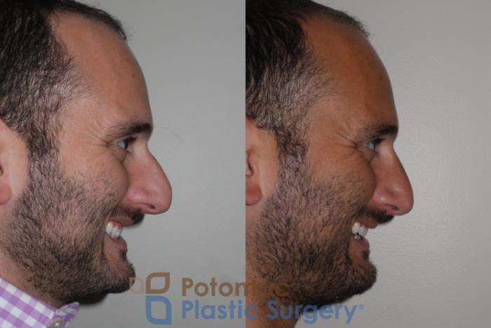 Before & After Rhinoplasty - Medical Case 132 Right Side View #2 View in Washington DC & Arlington , DC