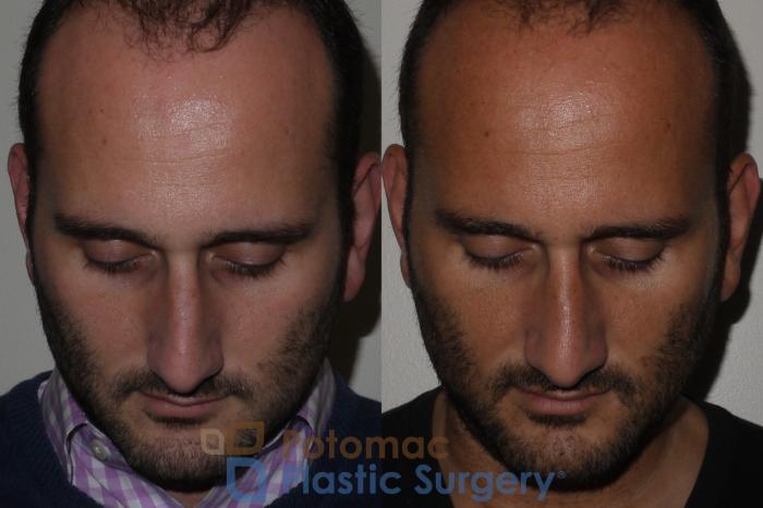 Before & After Rhinoplasty - Cosmetic Case 132 Top View in Washington DC & Arlington , DC
