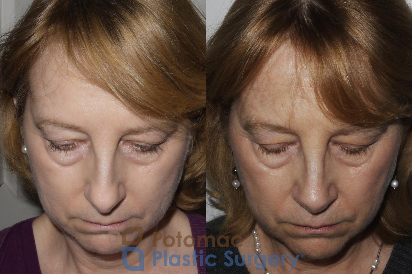 Before & After Rhinoplasty - Medical Case 160 Above View in Washington DC & Arlington , DC