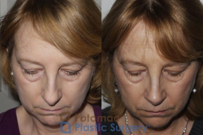Before & After Rhinoplasty - Medical Case 160 Above View in Washington, DC