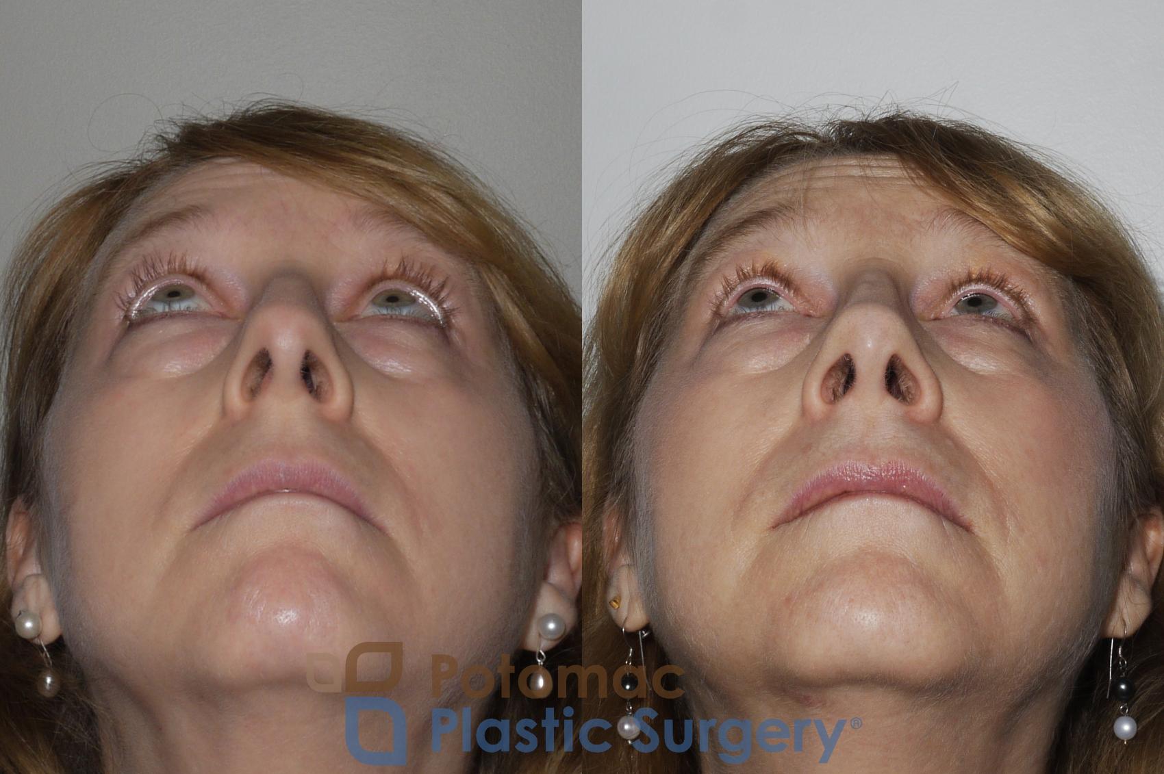 Before & After Rhinoplasty - Medical Case 160 Below View in Washington DC & Arlington , DC