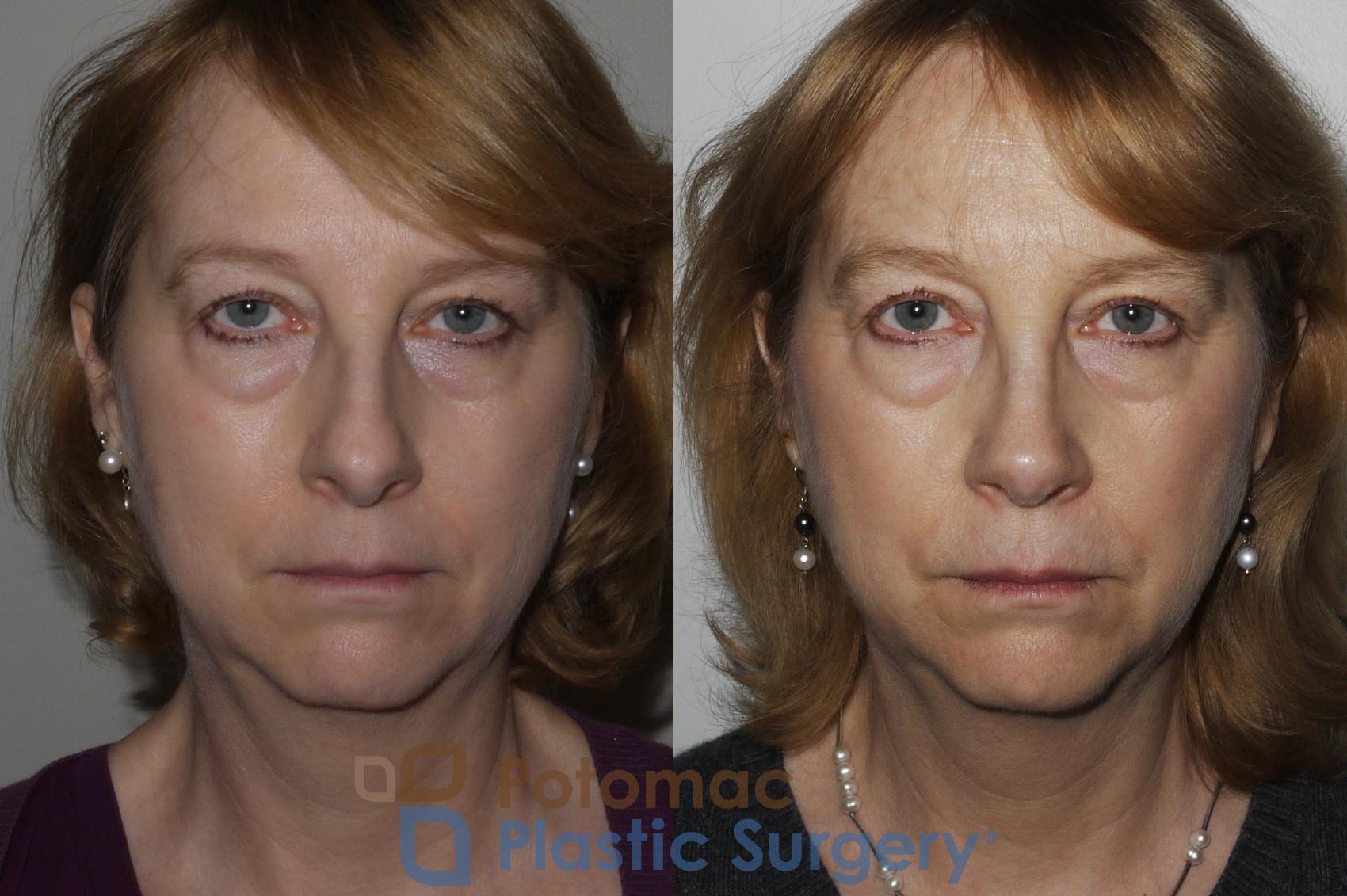 Before & After Rhinoplasty - Medical Case 160 Front View in Washington, DC