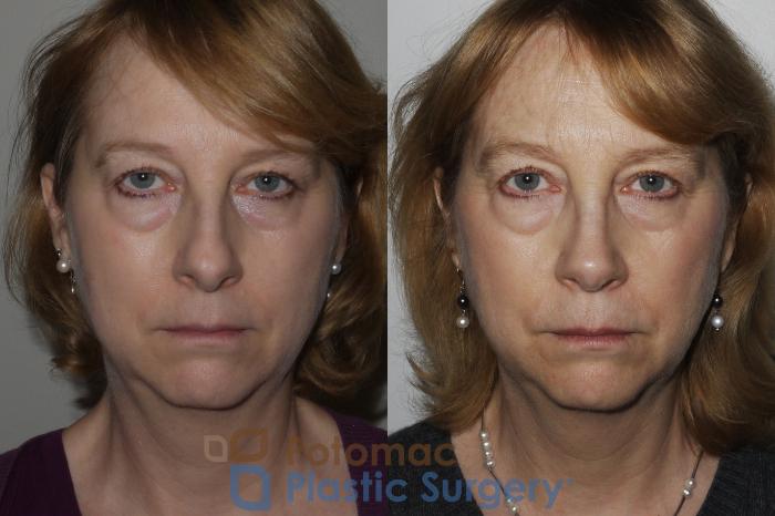 Before & After Rhinoplasty - Cosmetic Case 160 Front View in Washington DC & Arlington , DC
