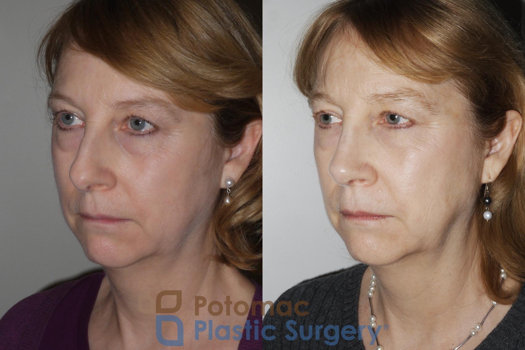 Before & After Rhinoplasty - Medical Case 160 Left Oblique View in Washington DC & Arlington , DC