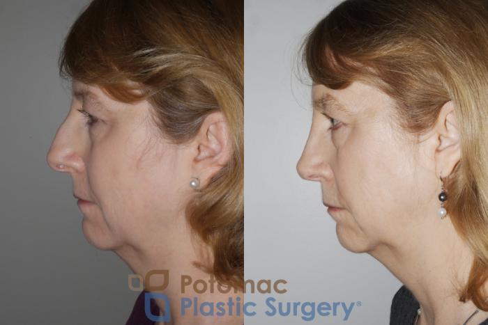 Before & After Rhinoplasty - Cosmetic Case 160 Left Side View in Washington DC & Arlington , DC