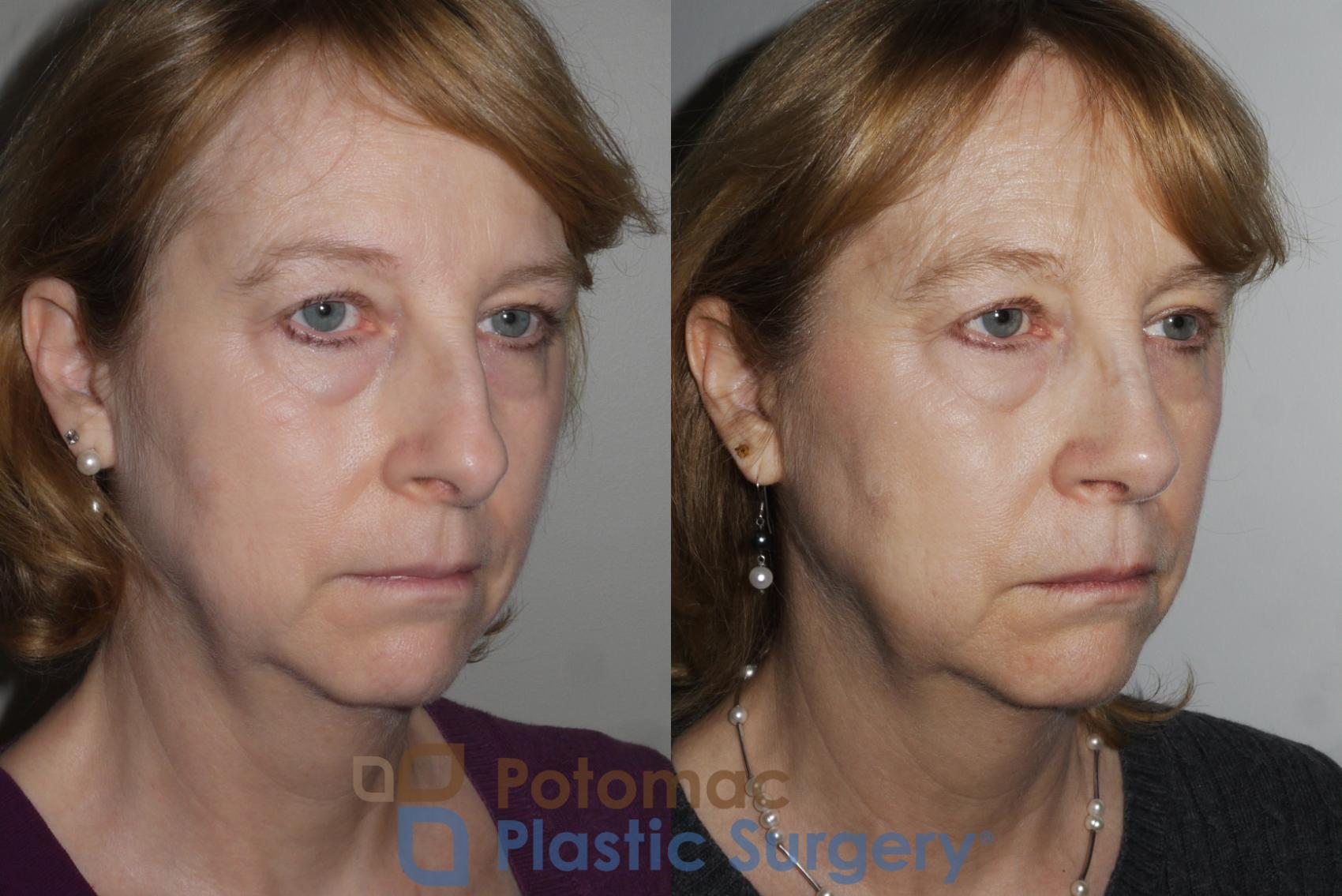 Before & After Rhinoplasty - Medical Case 160 Right Oblique View in Washington DC & Arlington , DC