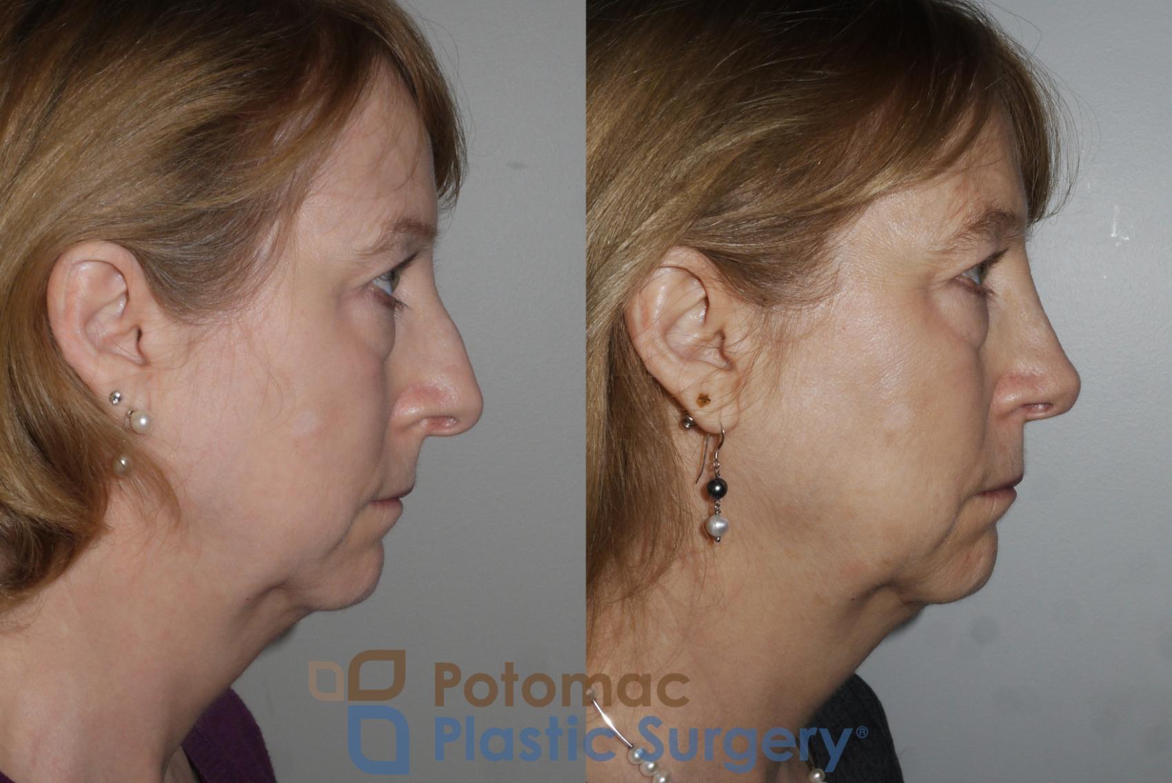 Before & After Rhinoplasty - Medical Case 160 Right Side View in Washington DC & Arlington , DC