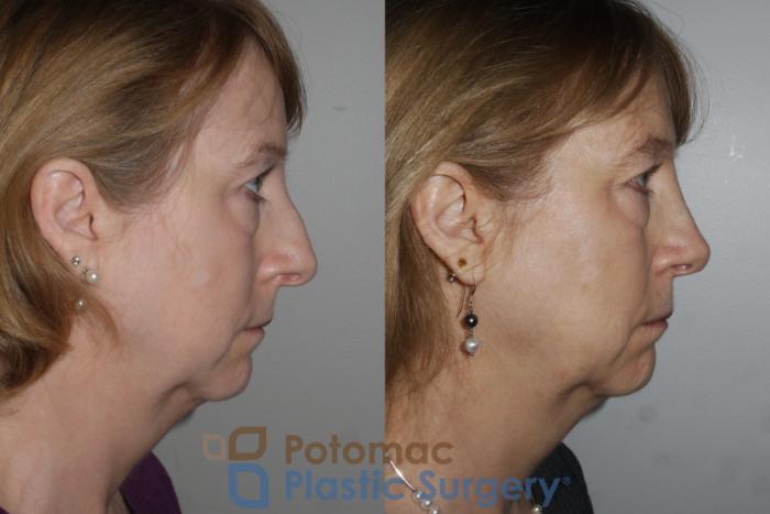 Before & After Rhinoplasty - Cosmetic Case 160 Right Side View in Washington DC & Arlington , DC