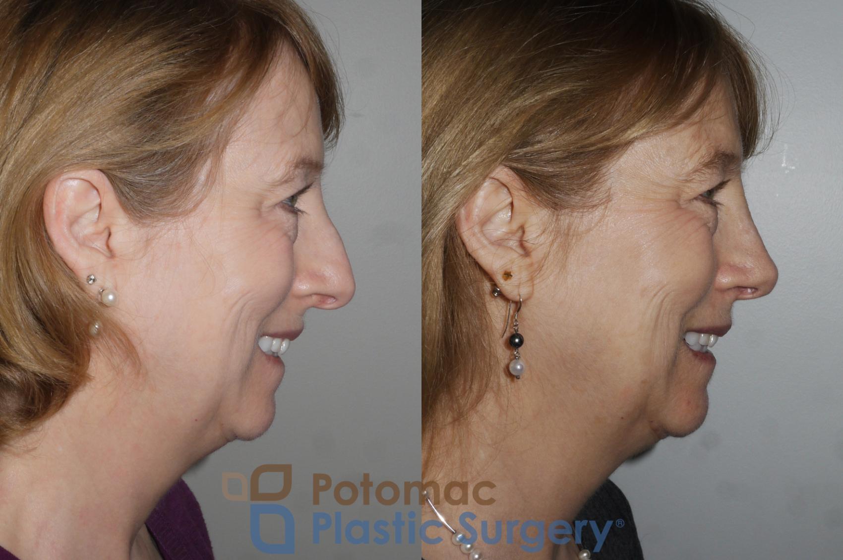 Before & After Rhinoplasty - Medical Case 160 Right Side View #2 View in Washington DC & Arlington , DC