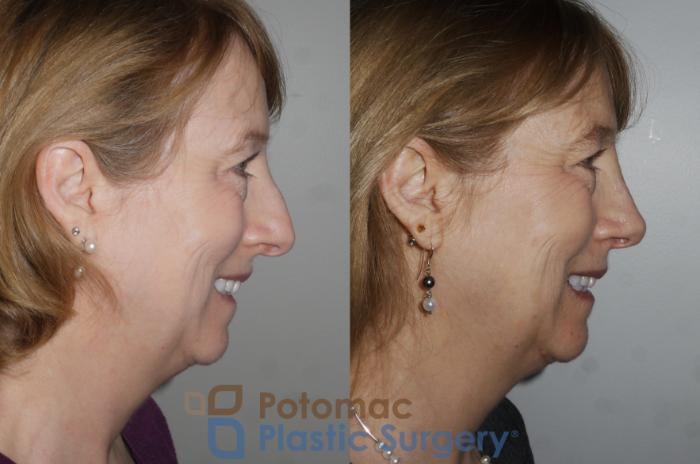 Before & After Rhinoplasty - Cosmetic Case 160 Right Side View #2 View in Washington DC & Arlington , DC