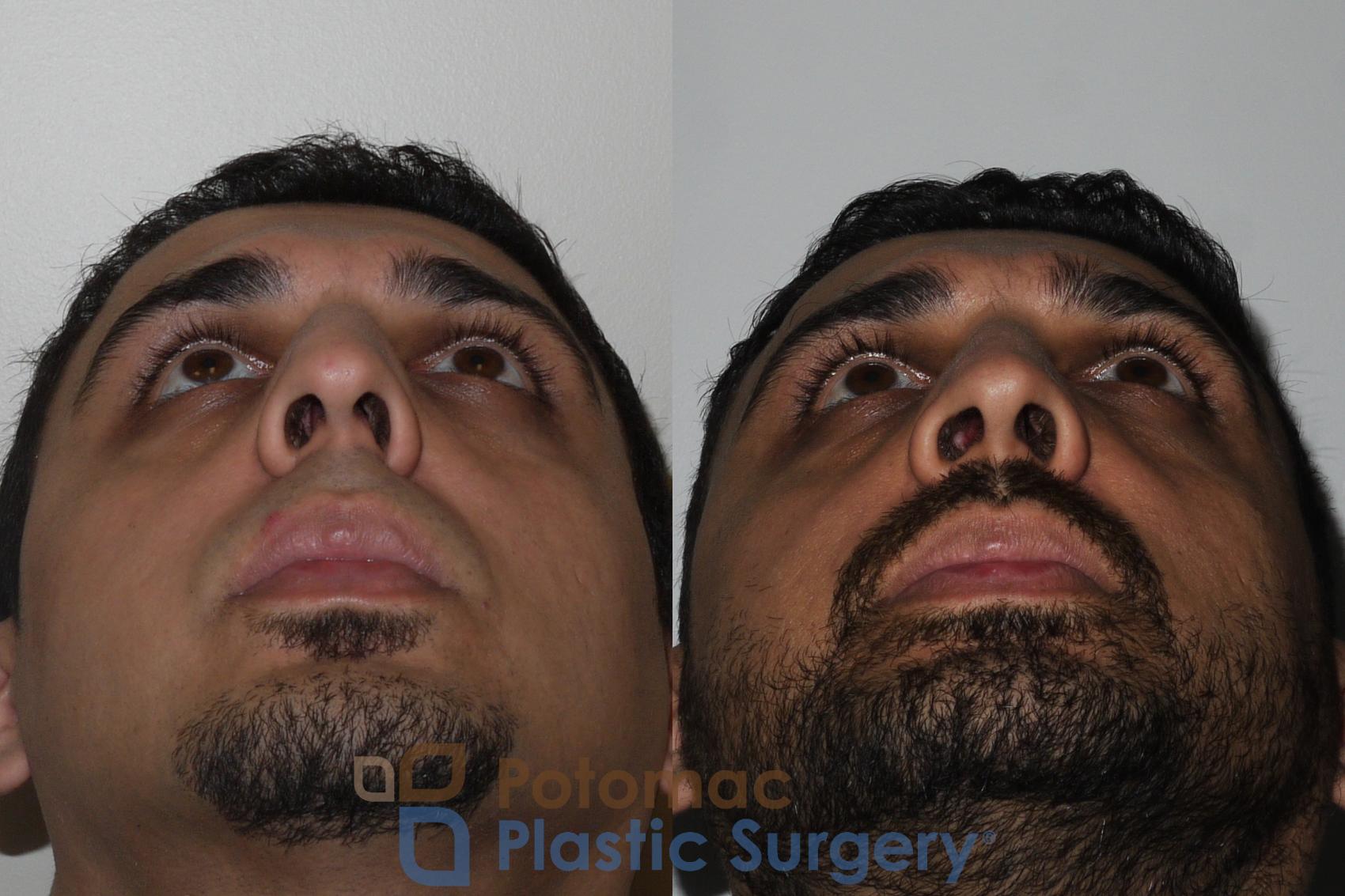 Before & After Rhinoplasty - Medical Case 168 Below View in Washington, DC