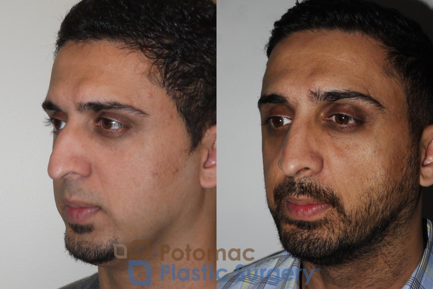 Before & After Rhinoplasty - Medical Case 168 Left Oblique View in Washington, DC