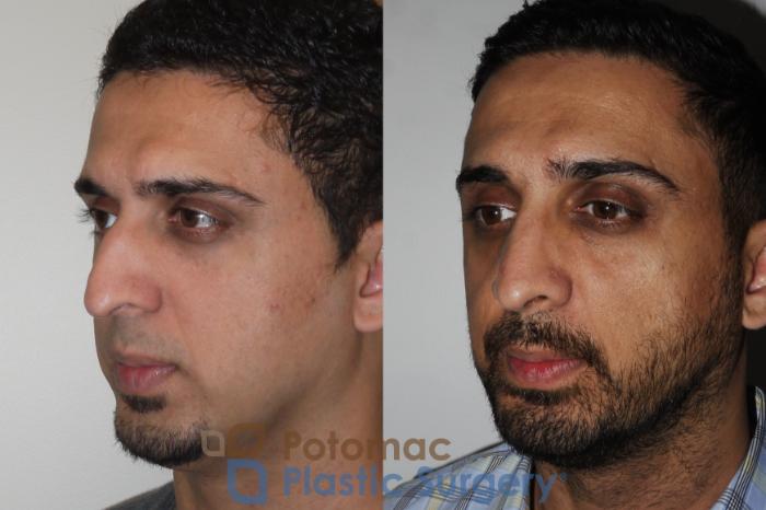 Before & After Rhinoplasty - Cosmetic Case 168 Left Oblique View in Washington, DC
