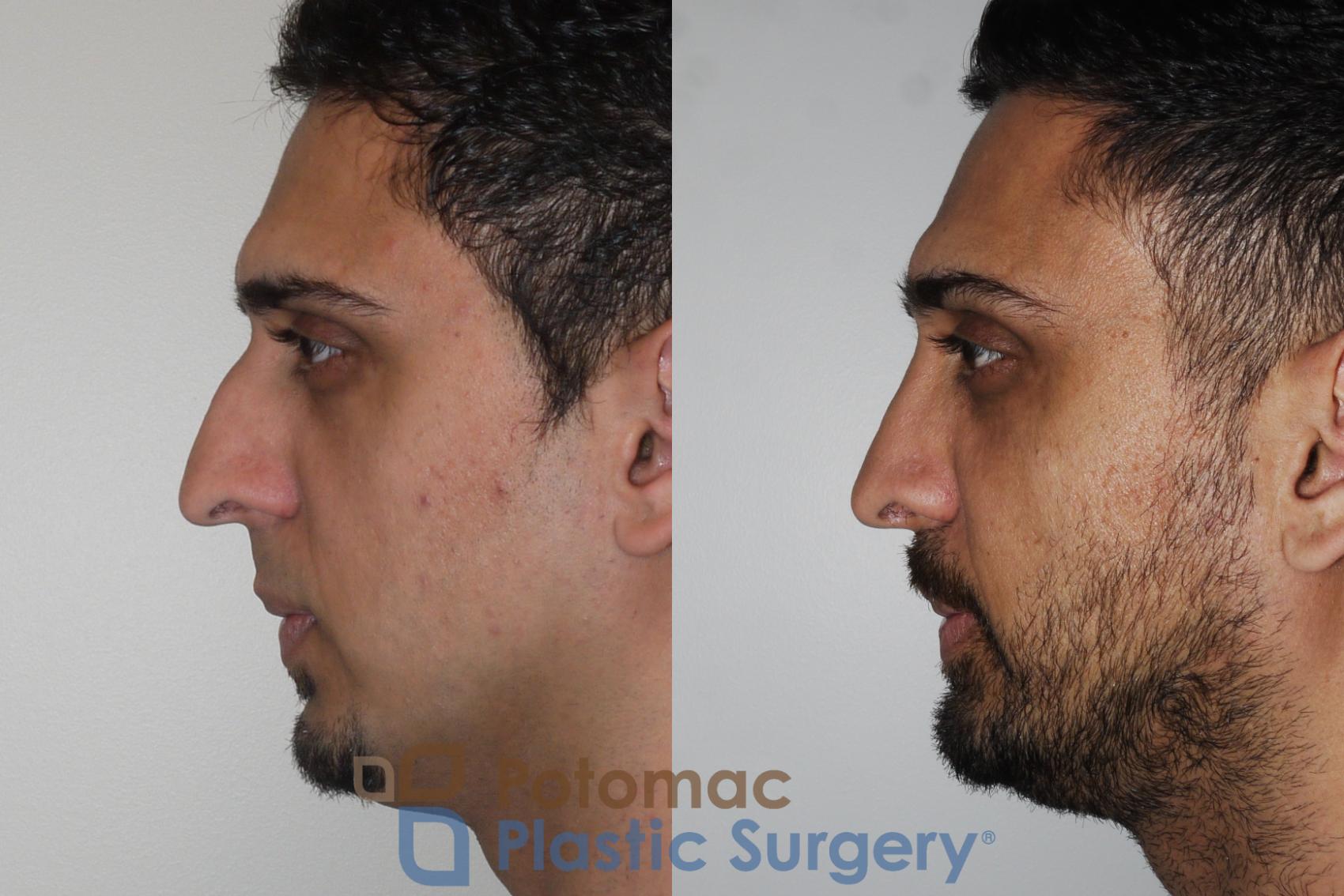 Before & After Rhinoplasty - Cosmetic Case 168 Left Side View in Washington DC & Arlington , DC