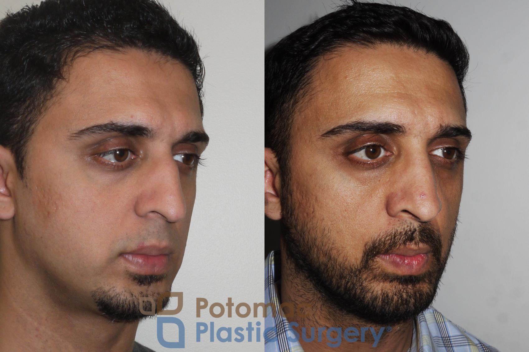 Before & After Rhinoplasty - Medical Case 168 Right Oblique View in Washington, DC