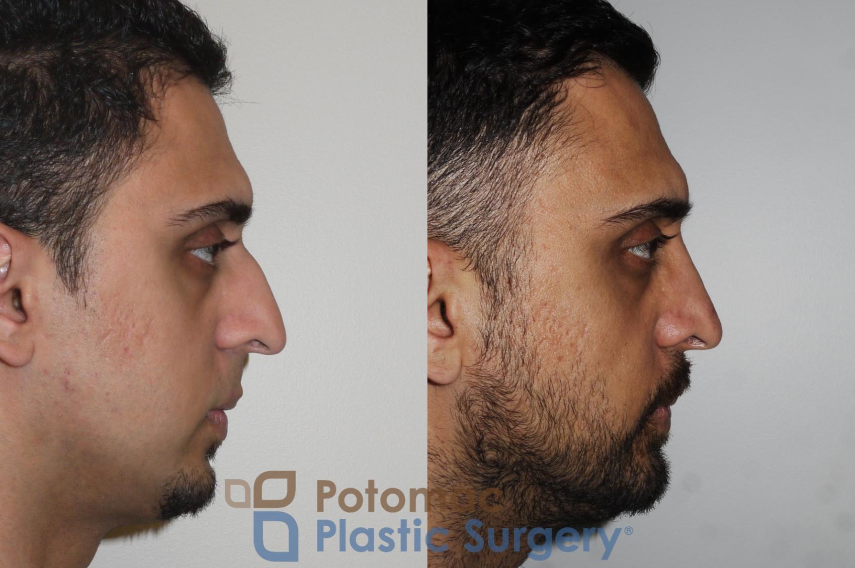 Before & After Rhinoplasty - Medical Case 168 Right Side View in Washington, DC