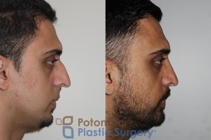 Before & After Rhinoplasty - Cosmetic Case 168 Right Side View in Washington, DC