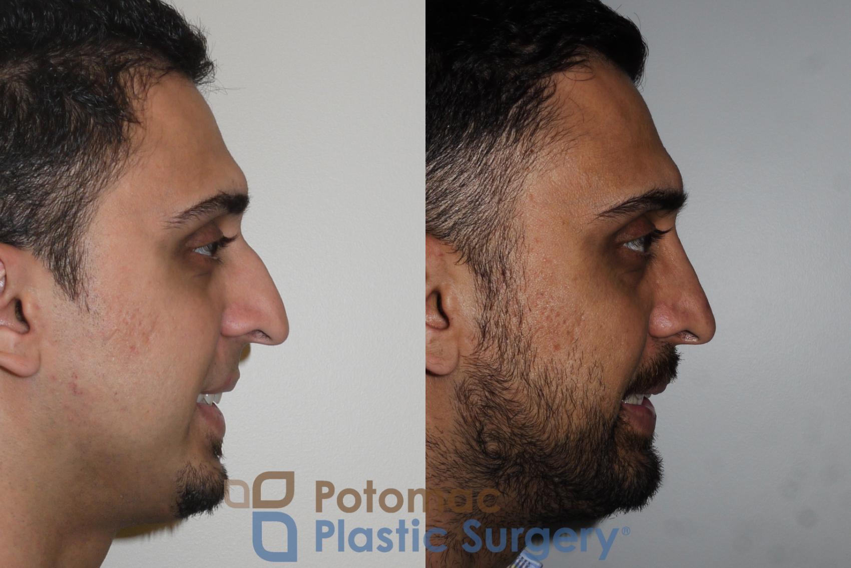 Before & After Rhinoplasty - Medical Case 168 Right Side View #2 View in Washington, DC