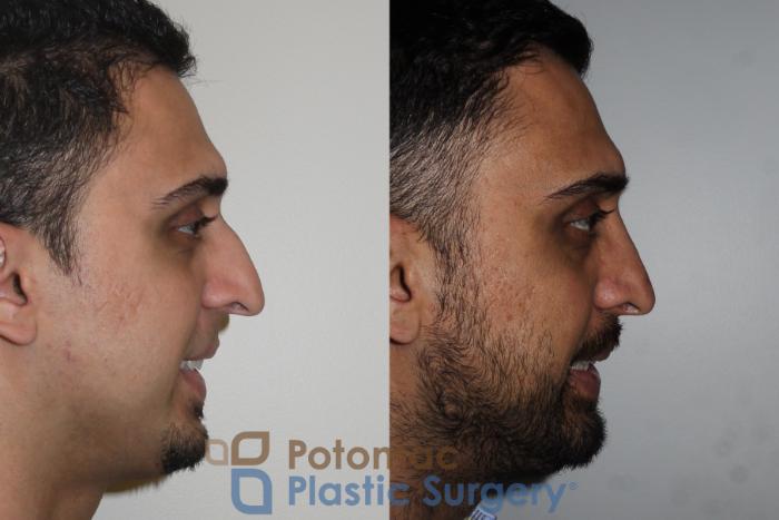 Before & After Rhinoplasty - Medical Case 168 Right Side View #2 View in Washington DC & Arlington , DC