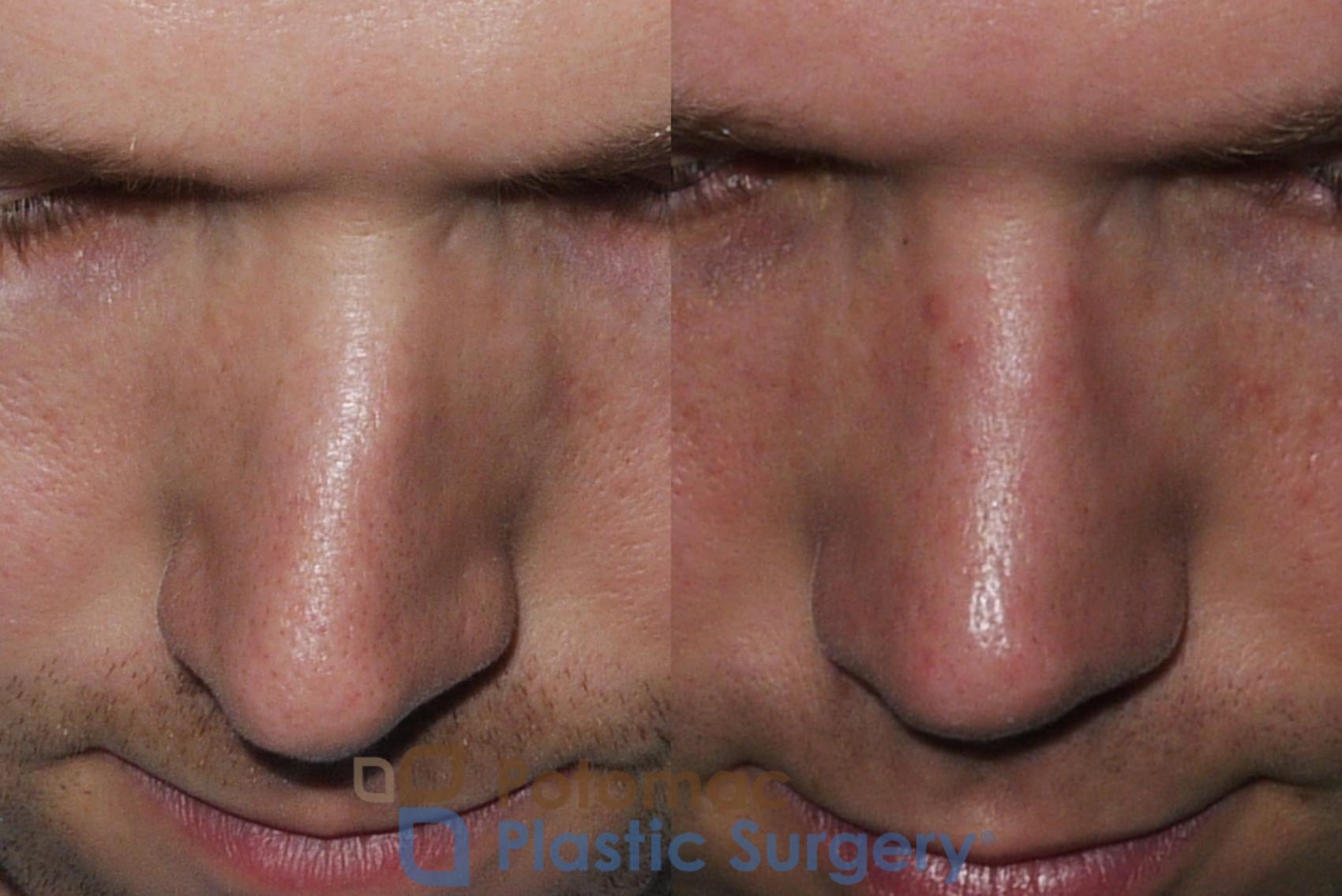 Before & After Rhinoplasty - Cosmetic Case 172 Above View in Washington DC & Arlington , DC