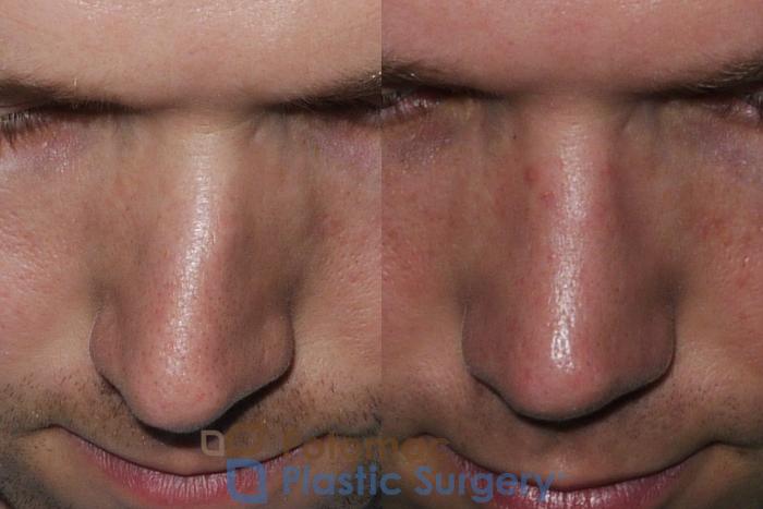 Before & After Rhinoplasty - Medical Case 172 Above View in Washington DC & Arlington , DC