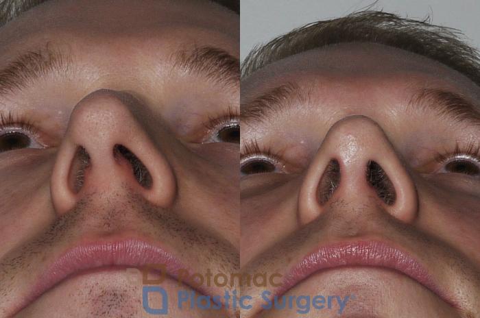 Before & After Rhinoplasty - Medical Case 172 Below View in Washington DC & Arlington , DC