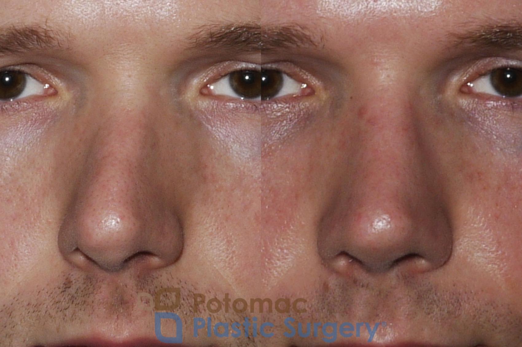 Before & After Rhinoplasty - Medical Case 172 Front View in Washington, DC