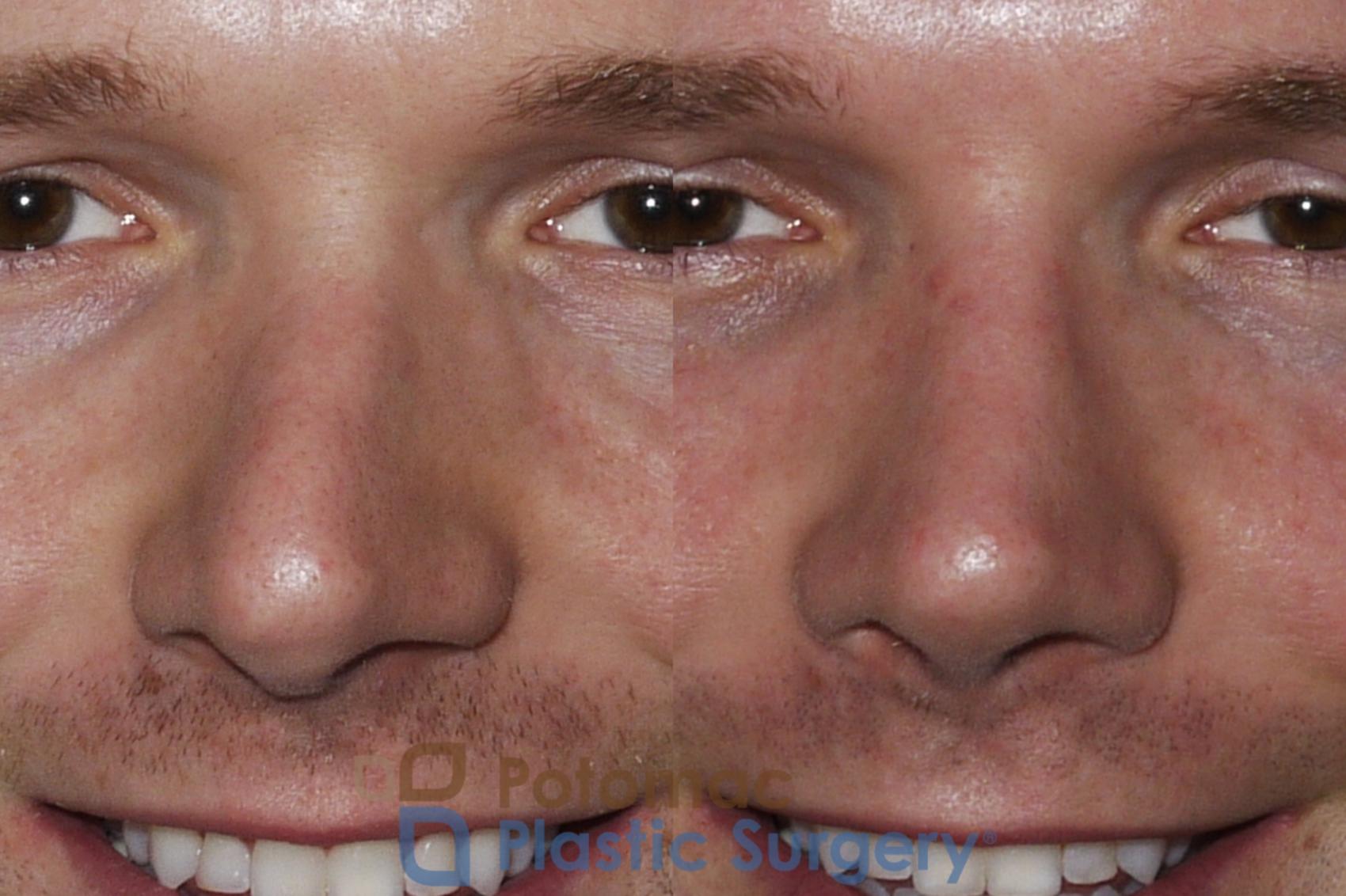 Before & After Rhinoplasty - Cosmetic Case 172 Front View #2 View in Washington DC & Arlington , DC