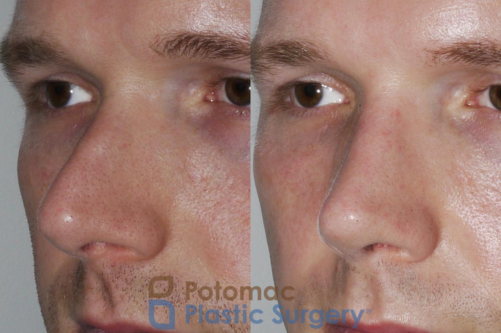 Before & After Rhinoplasty - Cosmetic Case 172 Left Oblique View in Washington DC & Arlington , DC