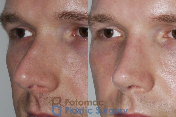 Before & After Rhinoplasty - Medical Case 172 Left Oblique View in Washington DC & Arlington , DC